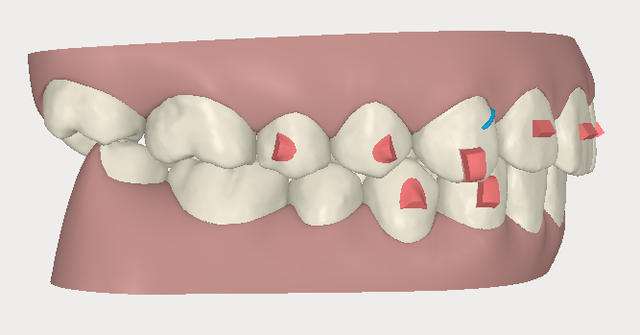 invisalign,[mC_