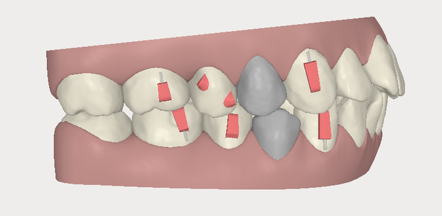 invisalign,[mC_