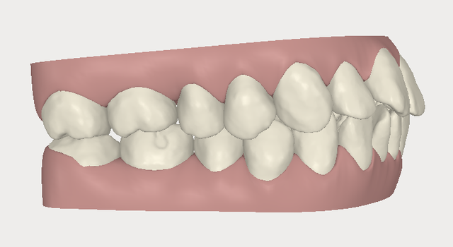 invisalign,[mC_