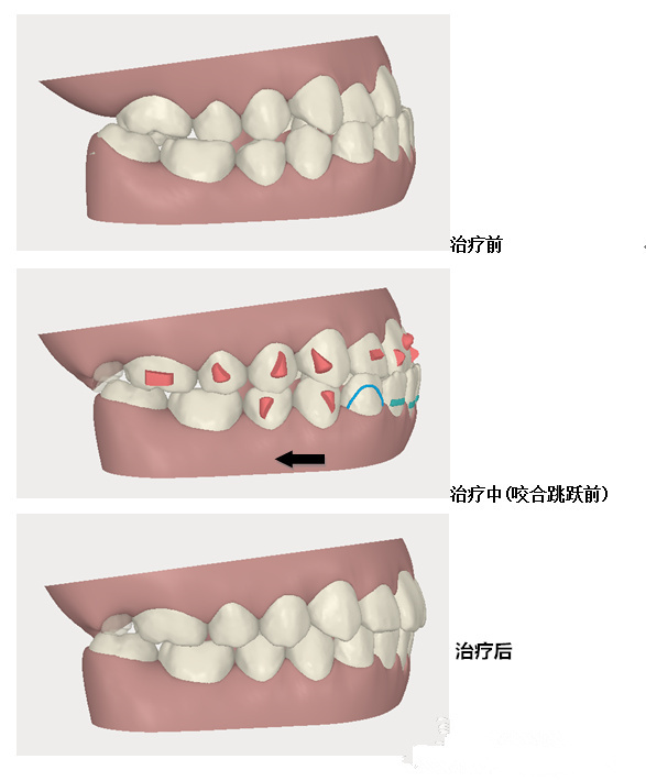 Invisalign[mίذ족ă(yu)ݺO(sh)Ӌ